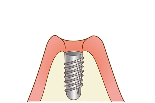 インプラント体の埋入