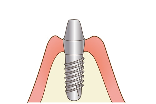 上部構造の取り付け