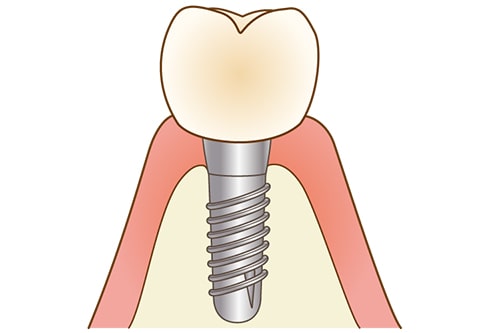 人工歯の取り付け