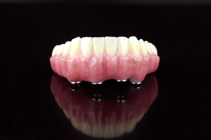 入れ歯とインプラントの性能「インプラントオーバーデンチャー」