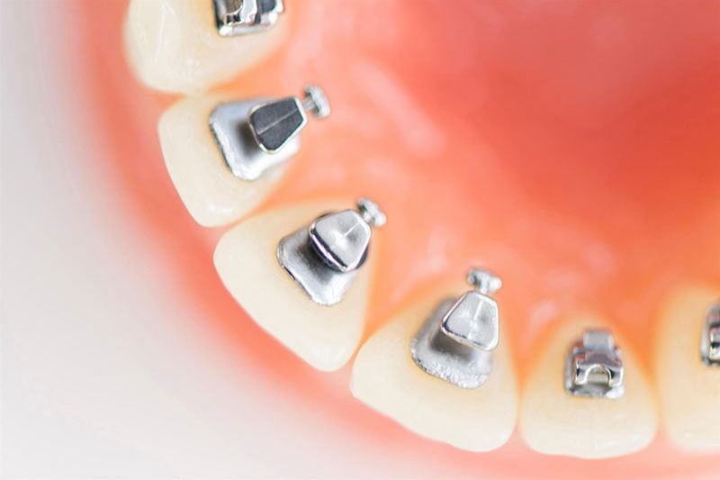 裏側（リンガル）矯正