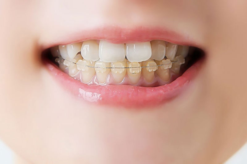 ハーフリンガル矯正