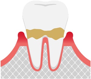 軽度歯周炎